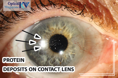 Protien depisites on contact lens